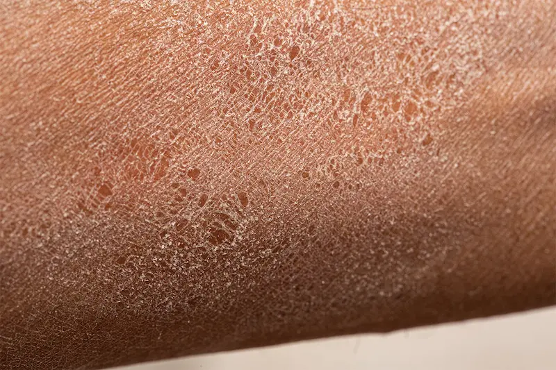 what causes dry skin 